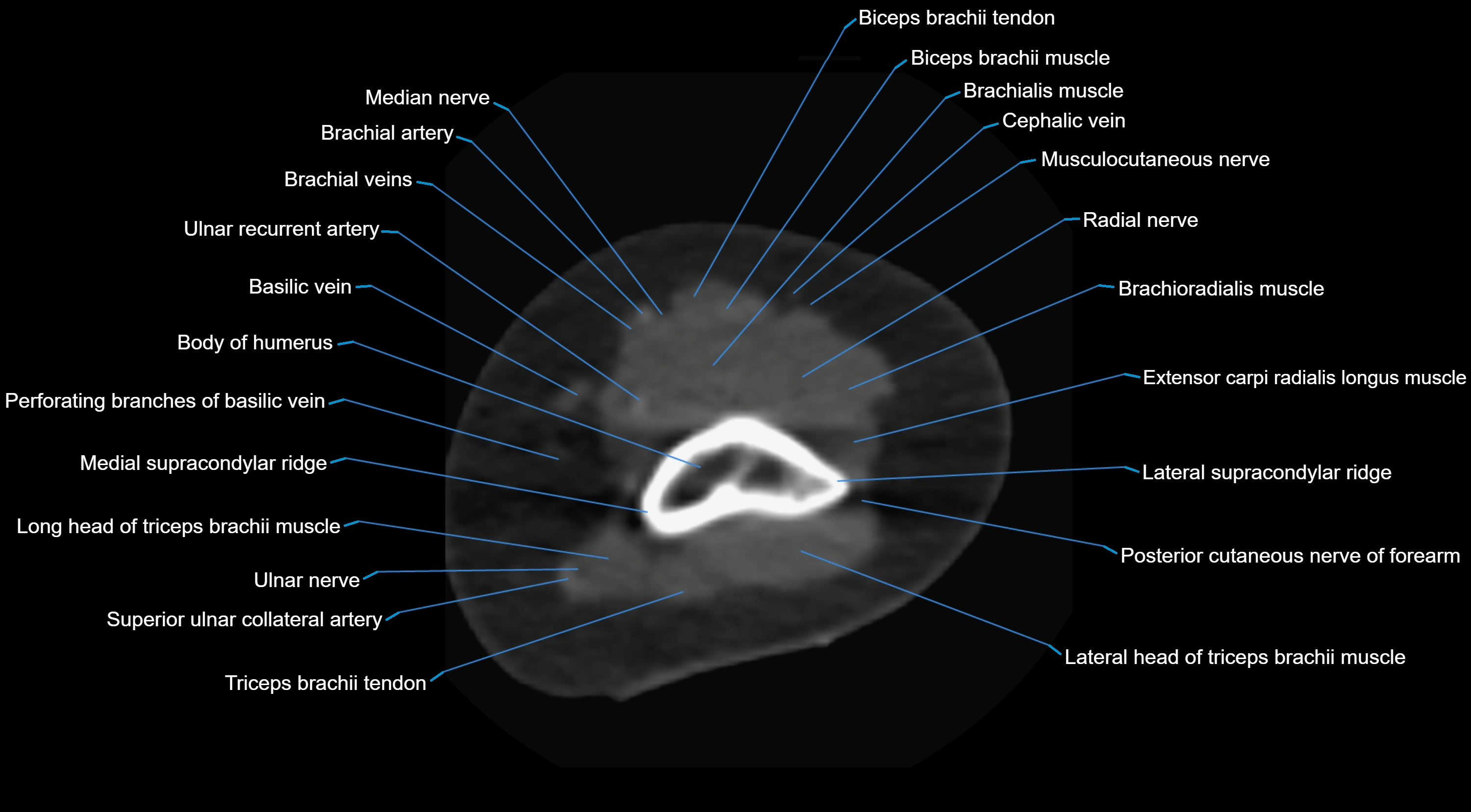 CT elbow axial  cross sectional anatomy labelled  radiology image -00007.webp